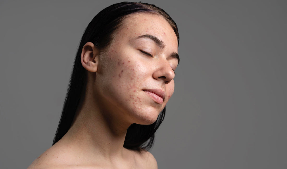 Do Non-Comedogenic Ingredients Really Matter, or Is It Just a Buzzword?